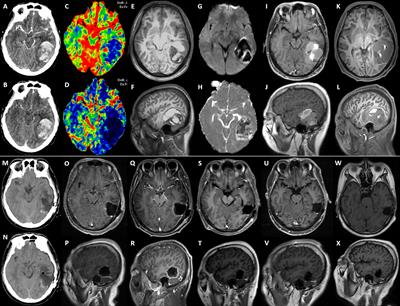 A Rare Manifestation of a Presumed Non-Osteophilic Brain Neoplasm: Extensive Axial Skeletal Metastases From Glioblastoma With Primitive Neuronal Components